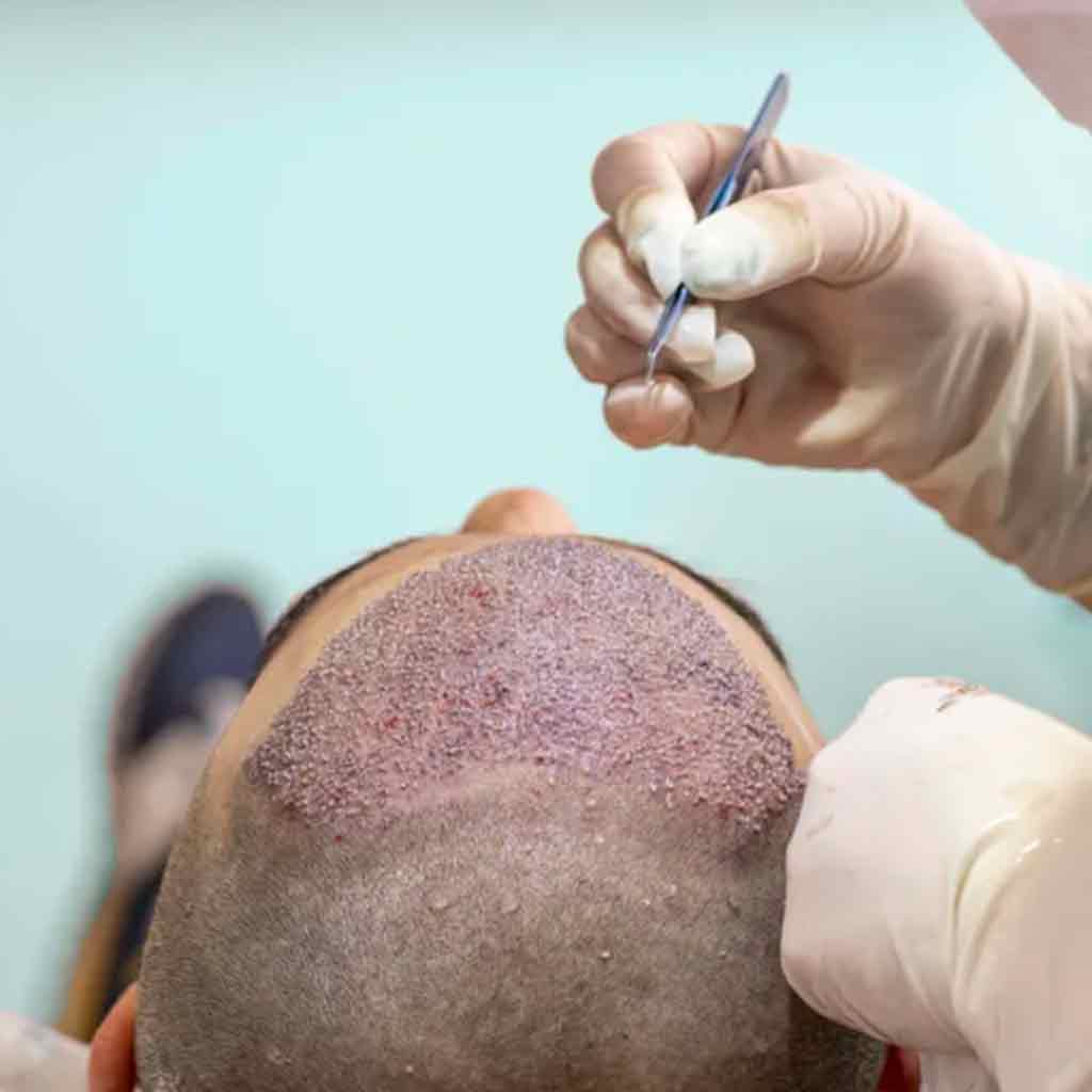 FUE Hair Transplant procedure showcasing skilled surgeons and advanced techniques in Peshawar.