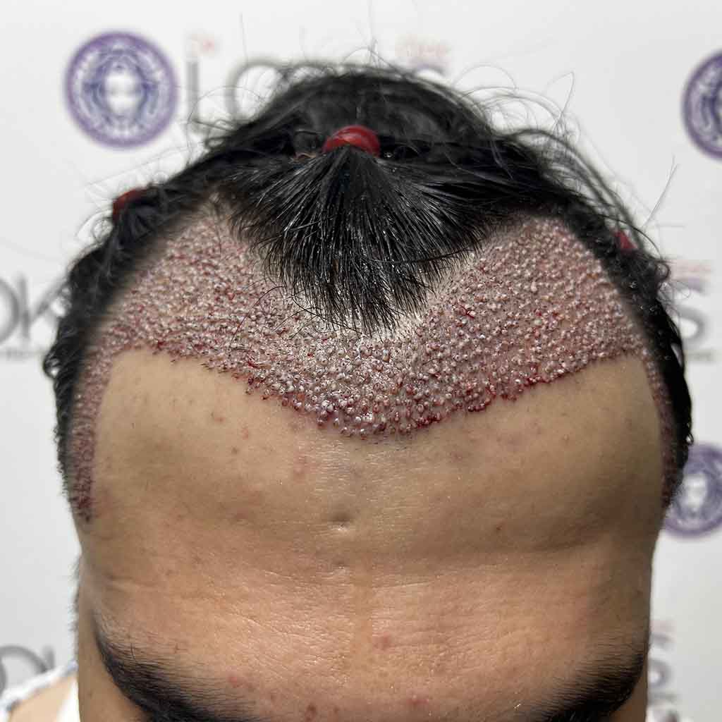 Unshaved Hair Transplant procedure showcasing discreet restoration without shaving the recipient area