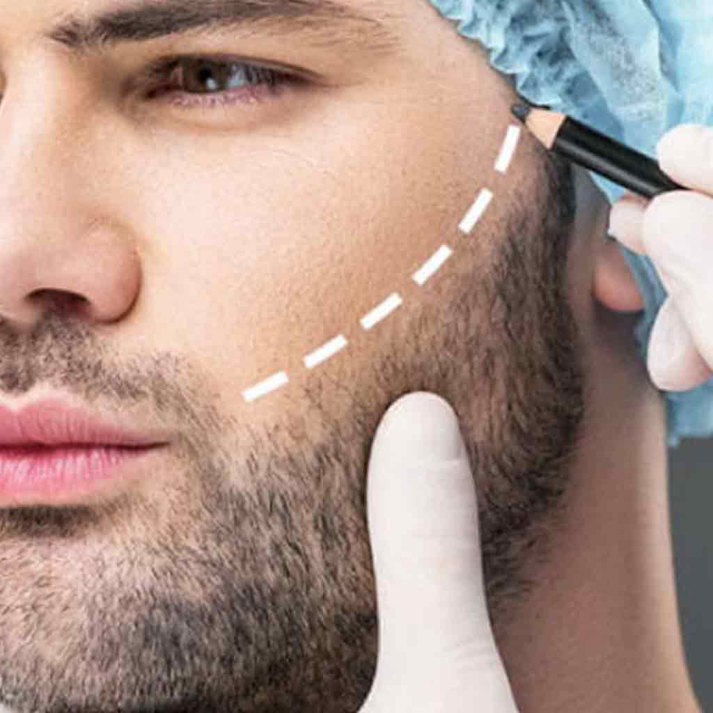 Beard and Mustache Transplant procedure showcasing expert craftsmanship for a perfectly tailored facial hair look